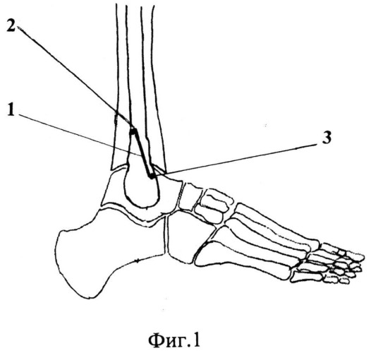 Способ лечения застарелых неправильно сросшихся пронационно-эверсионных переломов дистального отдела костей голени (патент 2528819)