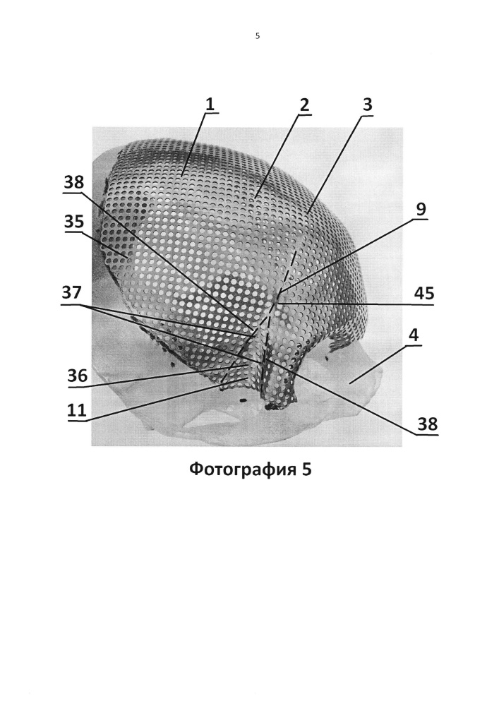 Имплантат для протезирования костей черепа и способ изготовления имплантата для протезирования костей черепа (патент 2638894)