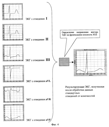 Устройство для регистрации результирующей экг на фронтальной и горизонтальной плоскостях (патент 2252695)