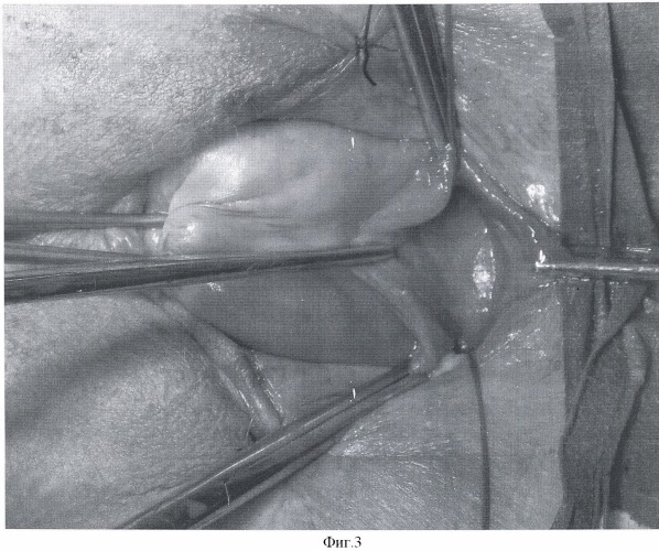 Способ хирургического лечения опущения передней стенки влагалища у женщин с сохраненной шейкой матки (патент 2476176)