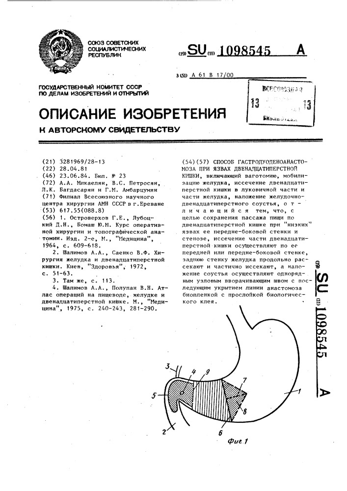 Способ гастродуоденоанастомоза при язвах двенадцатиперстной кишки (патент 1098545)