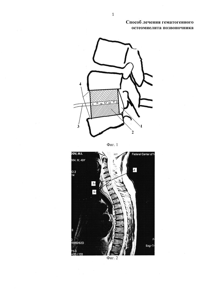 Способ лечения гематогенного остеомиелита позвоночника (патент 2614360)