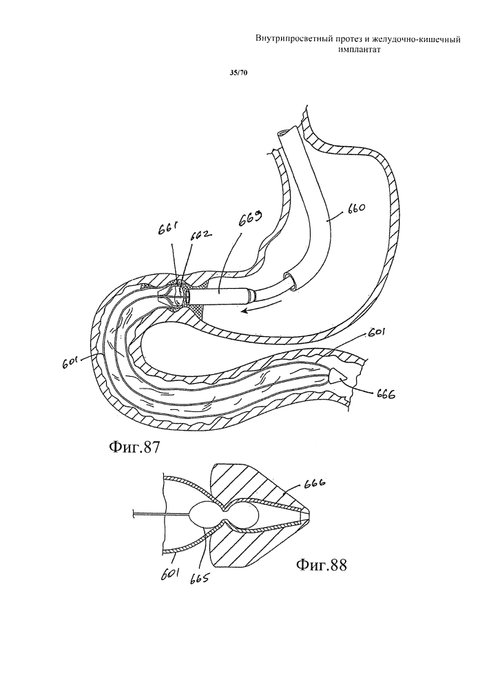 Внутрипросветный протез и желудочно-кишечный имплантат (патент 2626885)