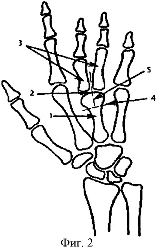 Способ реконструкции кисти при врожденной конкресценции центральных пястных костей у детей (патент 2373880)