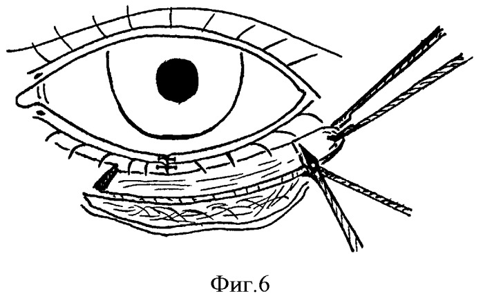 Способ устранения сенильного выворота нижнего века (патент 2380067)