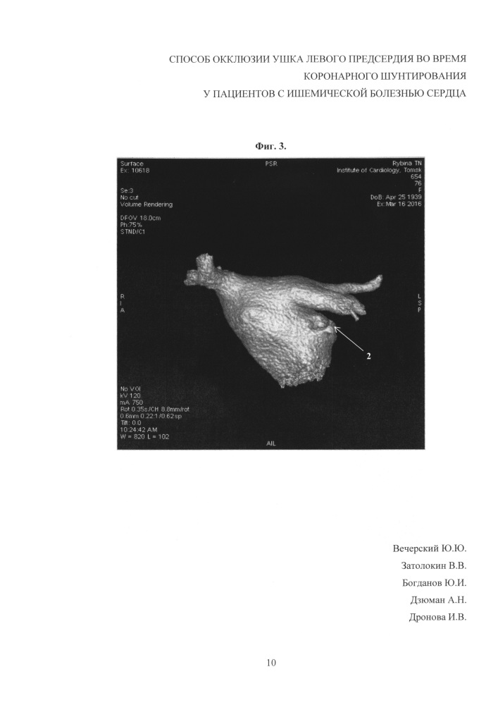 Способ окклюзии ушка левого предсердия во время коронарного шунтирования у пациентов с ишемической болезнью сердца (патент 2621954)