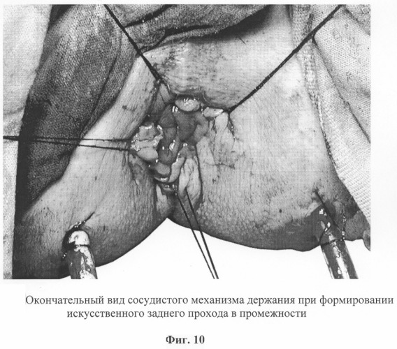 Способ восстановления сосудистого механизма держания при формировании искусственного заднего прохода (патент 2292846)