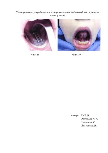 Универсальное устройство для измерения длины части уздечки языка у детей (патент 2584138)