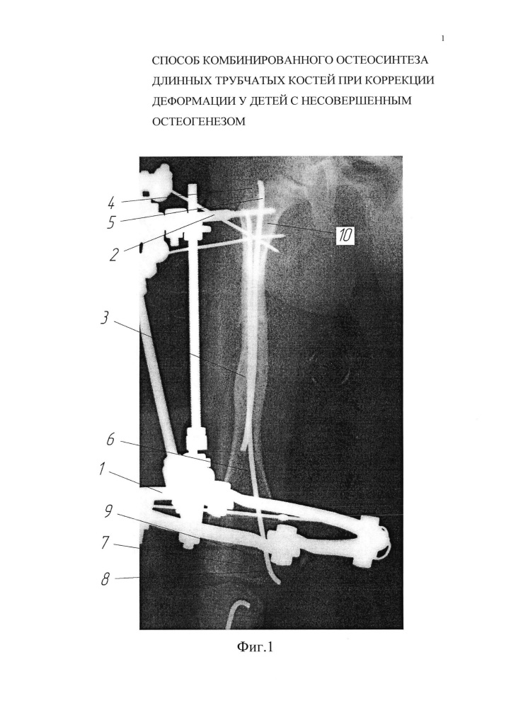 Способ комбинированного остеосинтеза длинных трубчатых костей при коррекции деформации у детей с несовершенным остеогенезом (патент 2615279)