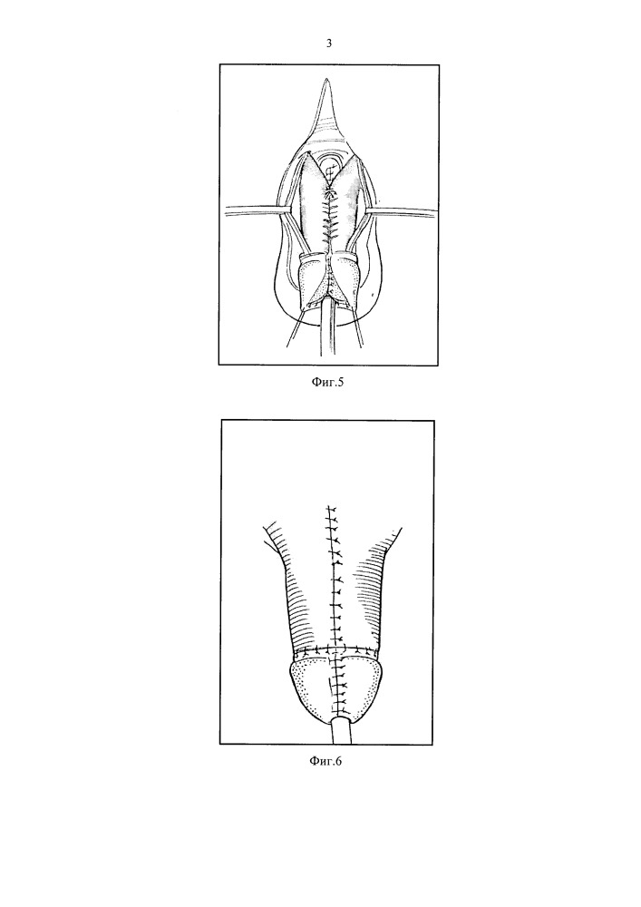Способ хирургического лечения порока развития полового члена при эписпадии и экстрофии мочевого пузыря у мальчиков (патент 2650200)