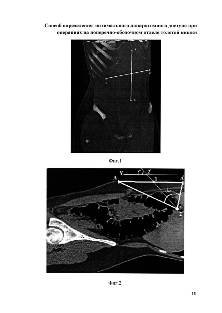 Способ определения оптимального лапаротомного доступа при операциях на поперечно-ободочном отделе толстой кишки (патент 2649571)