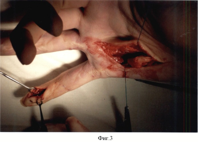 Способ сохранения сухожильного канала пальца при гнойном осложнении на первом этапе тендопластики (патент 2514347)