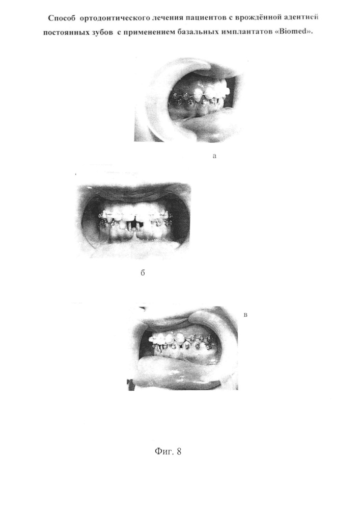 Способ ортодонтического лечения пациентов с врождённой адентией постоянных зубов с применением базальных имплантатов "biomed" (патент 2638286)