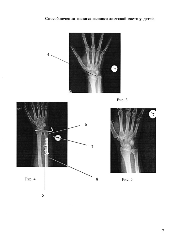 Способ лечения вывиха головки локтевой кости у детей (патент 2647178)