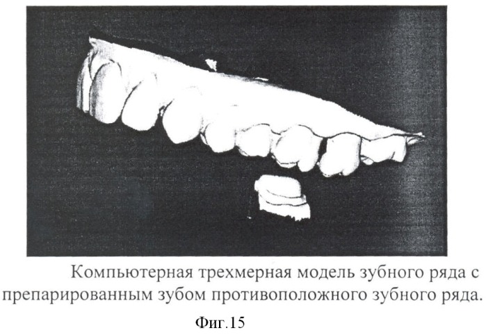 Способ воспроизведения зарегистрированных окклюзионных положений на компьютерных трехмерных моделях зубных рядов и ориентации компьютерных трехмерных моделей в пространстве (патент 2401083)