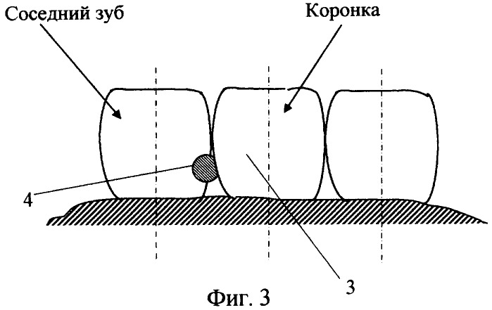 Коронка для дифференциальной диагностики этиологии аллергической реакции (патент 2326620)