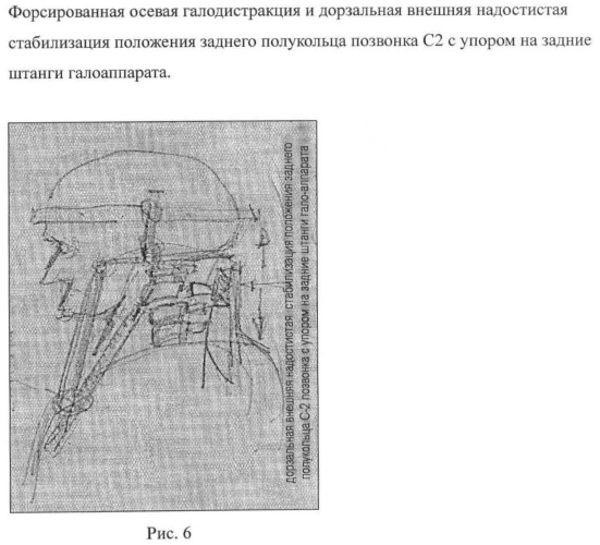 Способ анкерной коррекции и фиксации травматических дислокаций тела позвонка с2 при переломах палача (патент 2463978)
