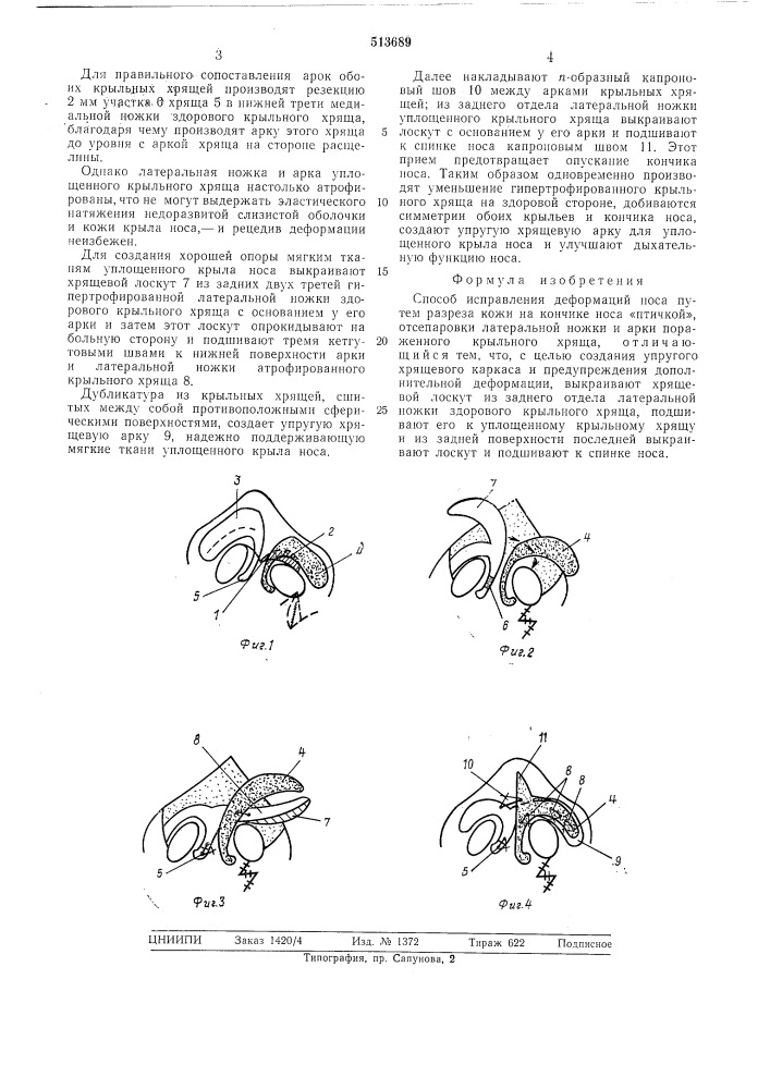 Способ исправления деформаций носа (патент 513689)