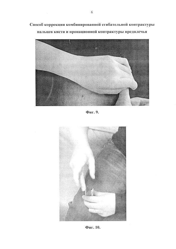 Способ коррекции комбинированной сгибательной контрактуры трехфаланговых пальцев кисти и пронационной контрактуры предплечья (патент 2627290)