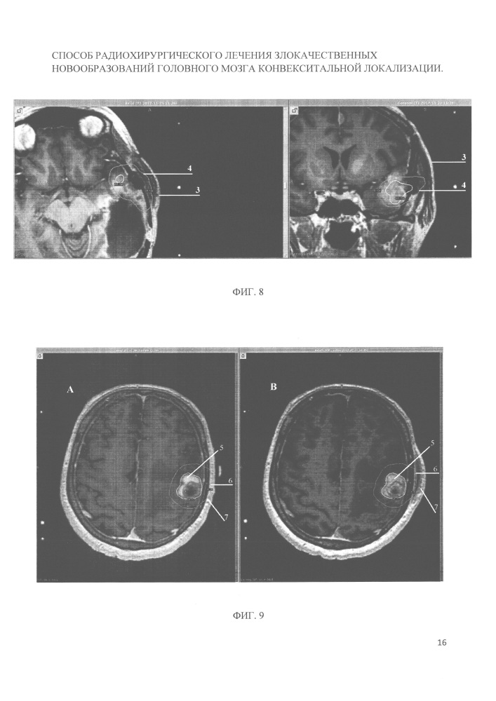 Способ радиохирургического лечения злокачественных новообразований головного мозга конвекситальной локализации (патент 2662204)