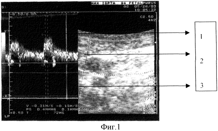 Способ диагностики цереброваскулярных резервов и прогнозирования сосудистой патологии зрительного нерва при дисциркуляторной энцефалопатии у геронтологических больных (патент 2316257)