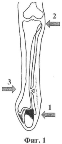 Трехуровневый способ ручной репозиции и внешней фиксации отломков лодыжек при лечении переломовывихов в голеностопном суставе (патент 2415652)
