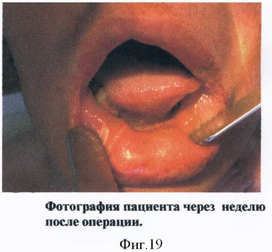Способ функциональной реабилитации больных, перенесших операции по поводу местнораспространенных опухолей дна полости рта и нижней челюсти (патент 2371141)