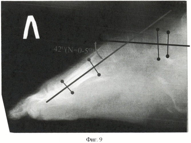 Способ остеосинтеза аппаратом орто-сув при деформациях среднего отдела стопы (патент 2489106)
