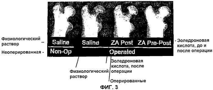 Лекарственное средство для лечения остеонекроза и для лечения пациентов с риском развития остеонекроза (патент 2284821)