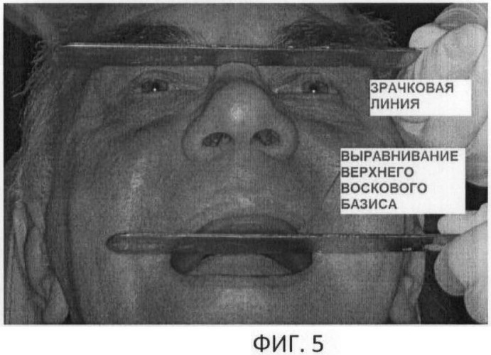 Способ определения расположения протетической верхней плоскости у пациентов с нарушениями целостности зубных рядов (патент 2470587)