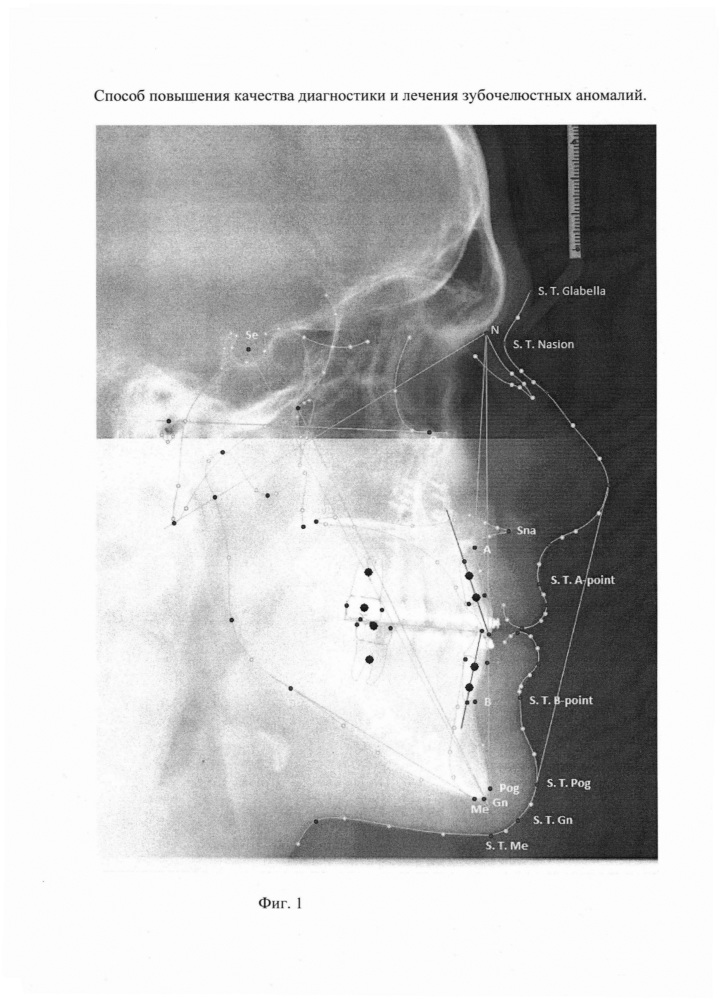 Способ повышения качества диагностики и лечения зубочелюстных аномалий (патент 2664594)