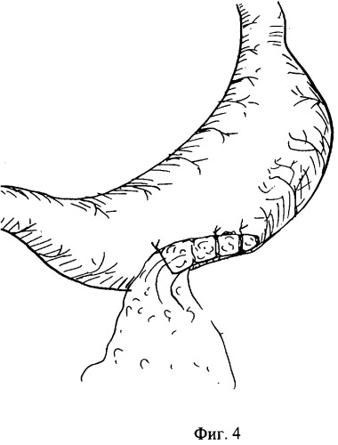 Способ ушивания прободной язвы желудка больших размеров при диффузном перитоните (патент 2296514)