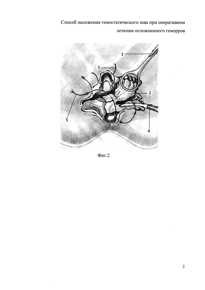 Способ обработки геморроидальной ножки при оперативном лечении осложненного внутреннего геморроя (патент 2614362)