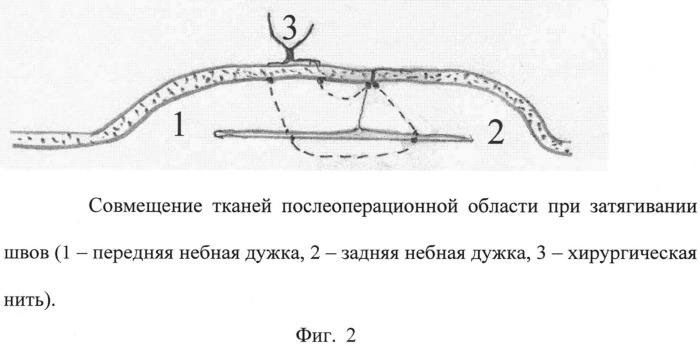 Способ хирургической профилактики кровотечения при тонзиллэктомии (патент 2546094)