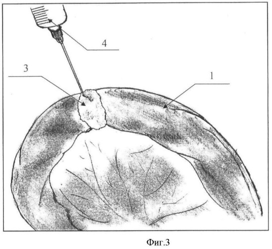 Способ герметизации межкишечного анастомоза (патент 2464942)