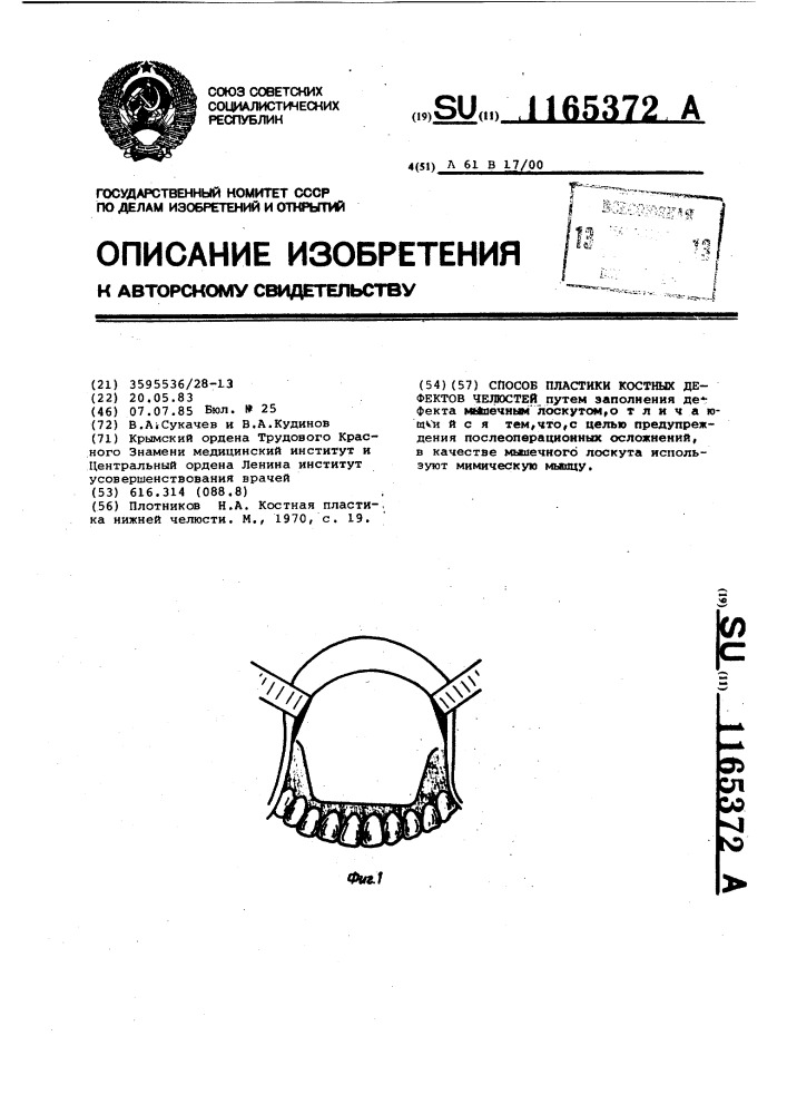 Способ пластики костных дефектов челюстей (патент 1165372)