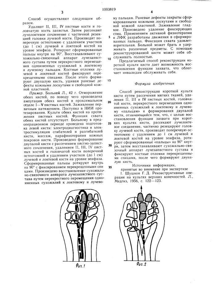 Способ реконструкции короткой культи кисти (патент 1003819)