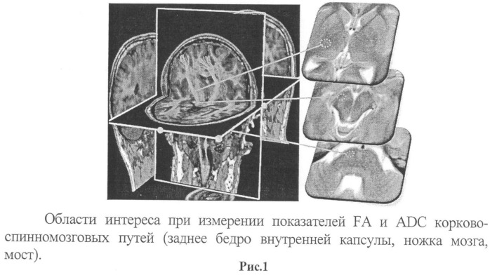 Способ прогнозирования восстановления двигательной функции у больных в остром периоде ишемического инсульта в бассейне артерий каротидной системы (патент 2508048)