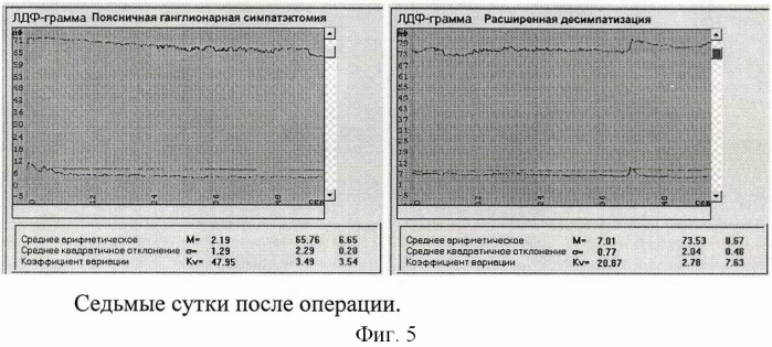 Способ комбинированной десимпатизации у больных с хронической ишемией нижних конечностей (патент 2441603)