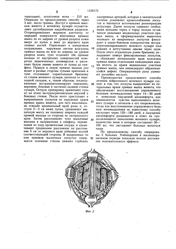 Способ лечения нейрогенного мочевого пузыря (патент 1158172)