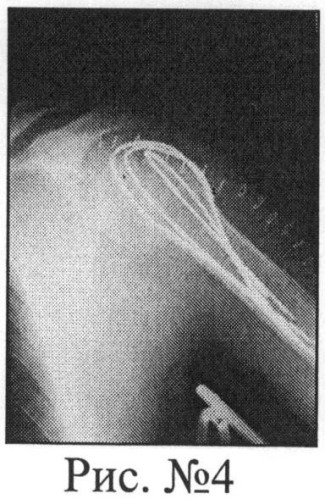 Способ хирургического лечения переломо-вывихов проксимального отдела плечевой кости напряженными спицами (патент 2483688)