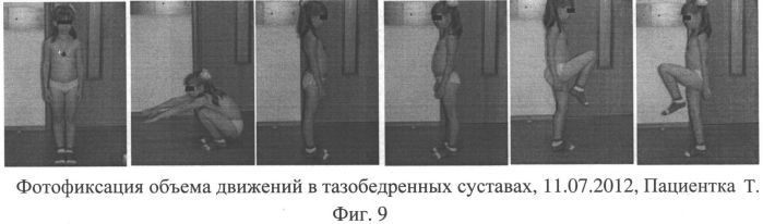 Способ лечения асептического некроза головки бедренной кости и сборы лекарственных растений для осуществления лечения (патент 2558476)