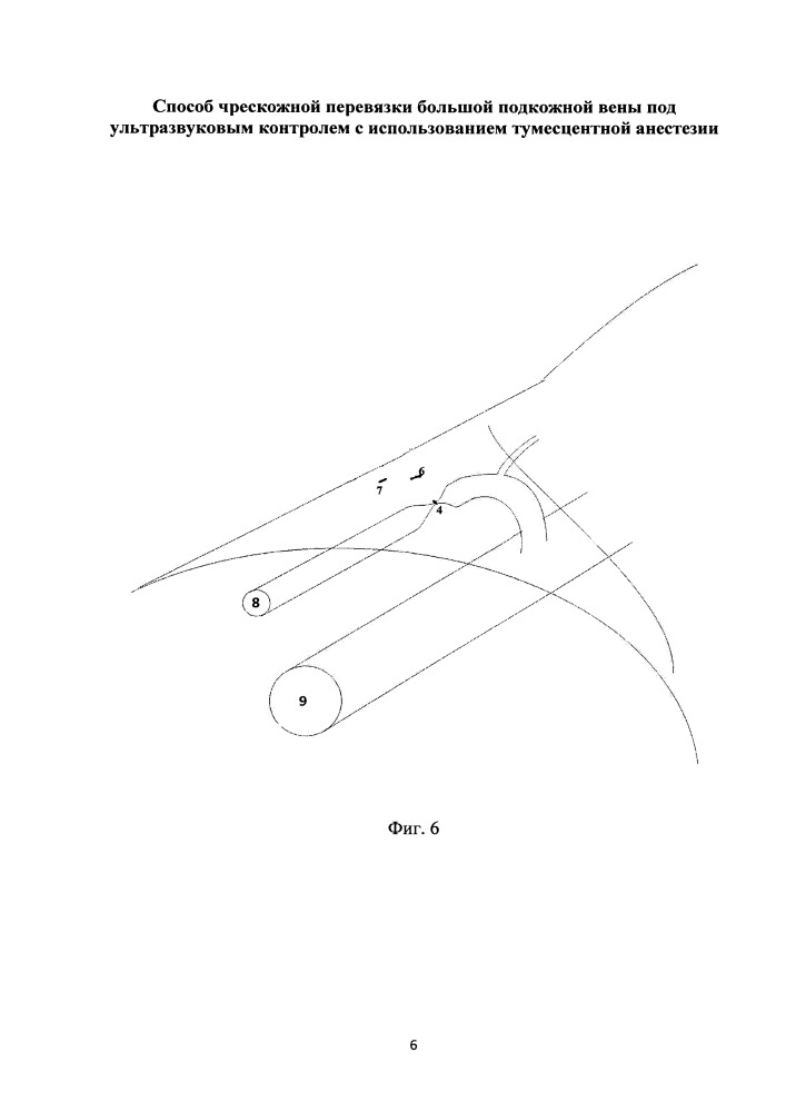 Способ чрескожной перевязки большой подкожной вены под ультразвуковым контролем с использованием тумесцентной анестезии (патент 2651081)