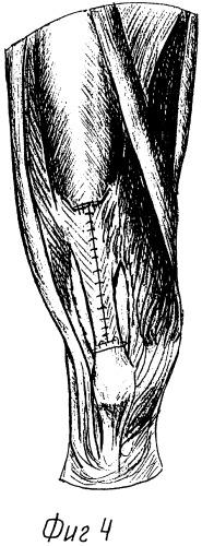 Способ сухожильно-мышечной пластики для восстановления проксимального отдела связки надколенника и прямой мышцы бедра при огнестрельных ранениях (патент 2313303)