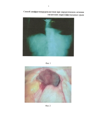 Способ диафрагмокруропластики при хирургическом лечении гигантских параэзофагеальных грыж (патент 2573794)