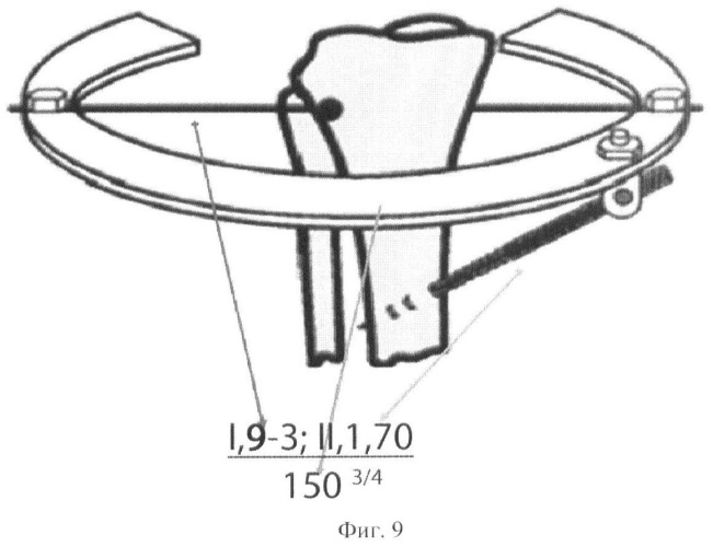 Способ остеосинтеза аппаратом орто-сув для лечения повреждений дистальной трети бедренной кости (патент 2448663)