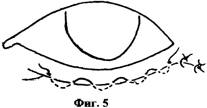 Способ хирургического лечения заворота нижнего века (патент 2342917)