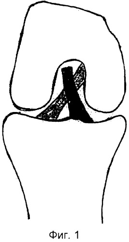 Способ лечения отрывов передней крестообразной связки коленного сустава (патент 2249437)
