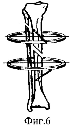 Способ чрескостного остеосинтеза костей голени (патент 2261675)