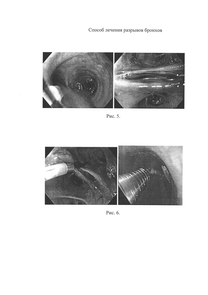 Способ лечения разрывов крупных бронхов (патент 2651691)
